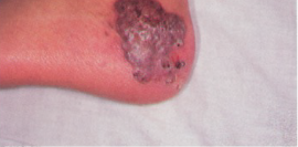 Granulomatous plaque of cutaneous aspergillosis on the left foot of a 13-year-old patient with Chronic Granulomatous Disease (CGD).